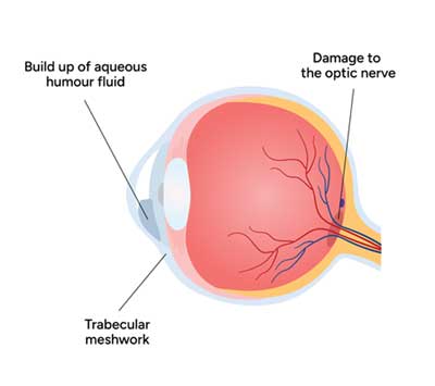 General Glaucoma Treatment